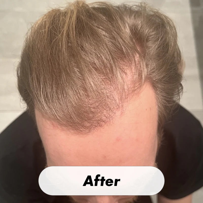 Hair Growth System Red Light Therapy Hair Loss Treatment Hair Care Cap