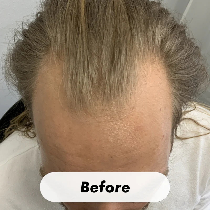 Hair Growth System Red Light Therapy Hair Loss Treatment Hair Care Cap