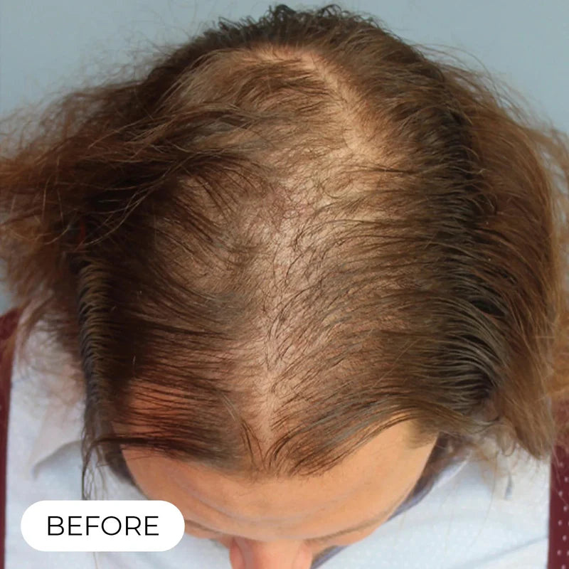 Hair Growth System Red Light Therapy Hair Loss Treatment Hair Care Cap