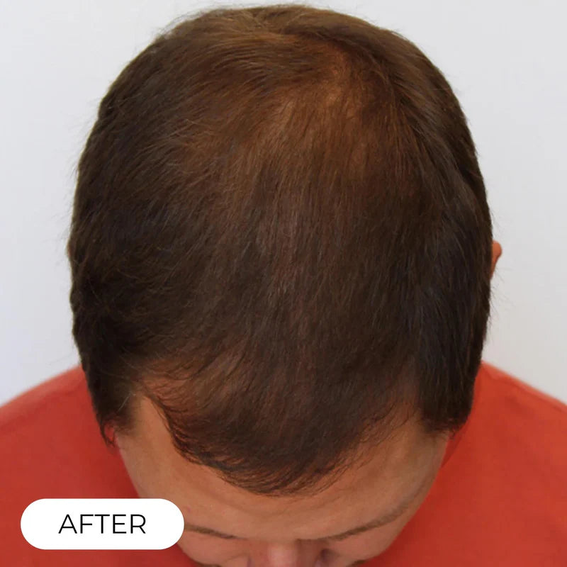 Hair Growth System Red Light Therapy Hair Loss Treatment Hair Care Cap